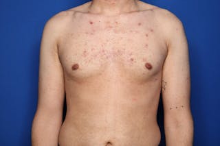 Gynecomastia (Male Breast Reduction) Before & After Gallery - Patient 227012 - Image 2