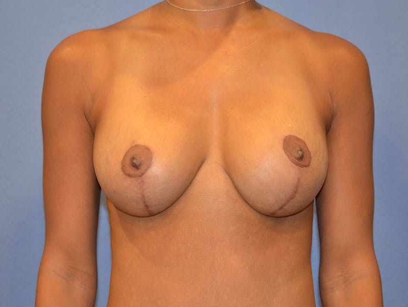 Breast Revision Before & After Gallery - Patient 402639 - Image 4