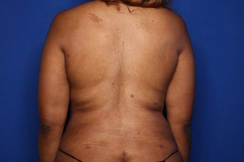 Tummy Tuck Before & After Gallery - Patient 346468 - Image 6