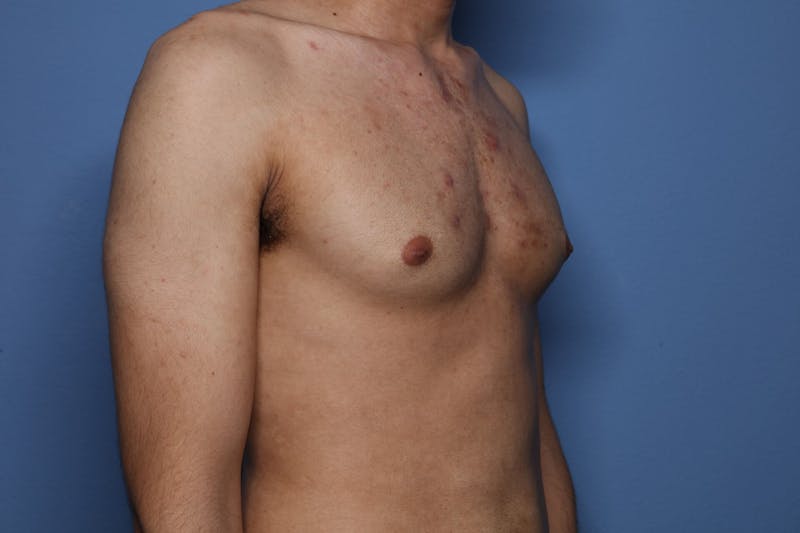 Gynecomastia (Male Breast Reduction) Before & After Gallery - Patient 227012 - Image 3