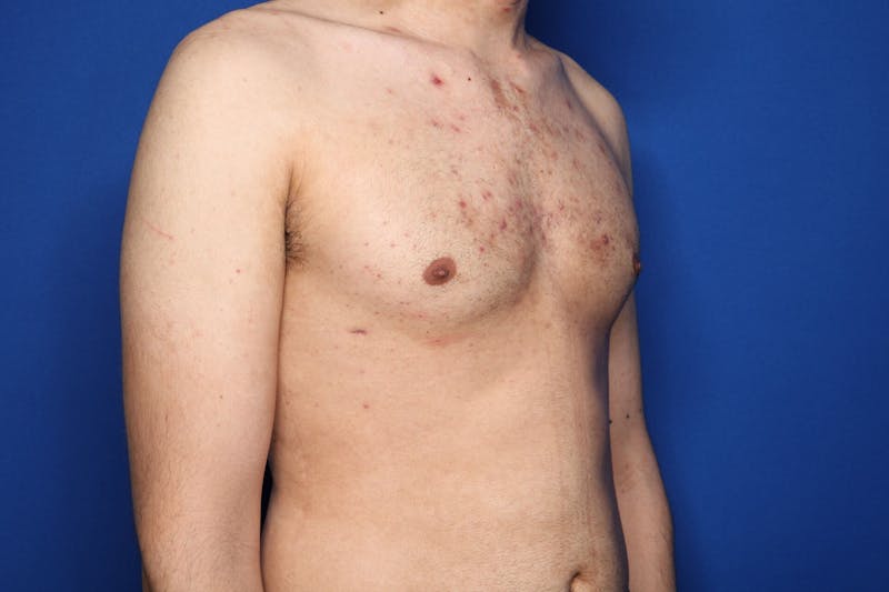 Gynecomastia (Male Breast Reduction) Before & After Gallery - Patient 227012 - Image 4