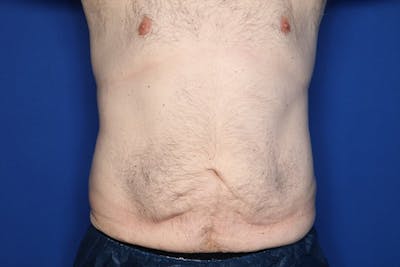Tummy Tuck Before & After Gallery - Patient 519003 - Image 1
