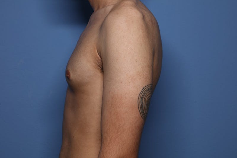 Gynecomastia (Male Breast Reduction) Before & After Gallery - Patient 227012 - Image 5