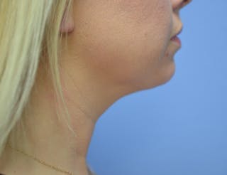 FaceTite Before and After Before & After Gallery - Patient 126999 - Image 4