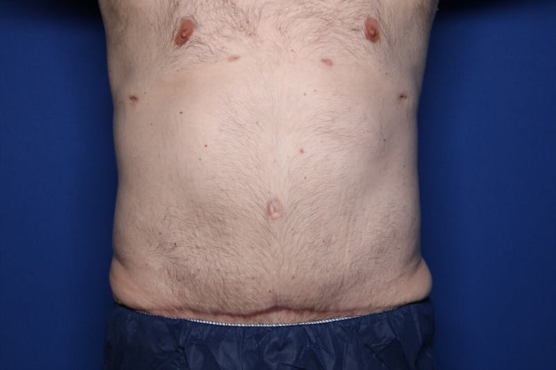 Tummy Tuck Before & After Gallery - Patient 519003 - Image 2