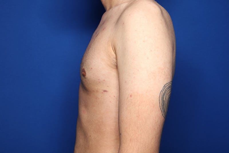 Gynecomastia (Male Breast Reduction) Before & After Gallery - Patient 227012 - Image 6