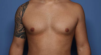 Gynecomastia (Male Breast Reduction) Before & After Gallery - Patient 421321 - Image 1