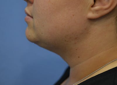 FaceTite™ Before & After Gallery - Patient 516391 - Image 2