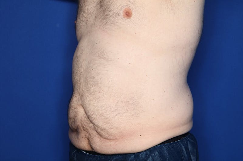Tummy Tuck Before & After Gallery - Patient 519003 - Image 5