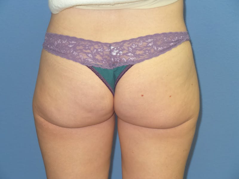 BodyTite™ Before & After Gallery - Patient 169959 - Image 4