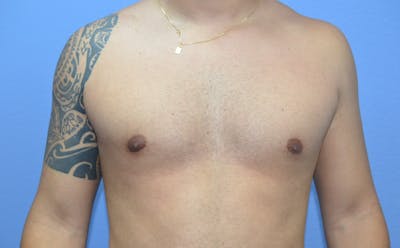 Gynecomastia (Male Breast Reduction) Before & After Gallery - Patient 421321 - Image 2