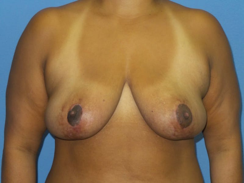 Breast Reduction Before & After Gallery - Patient 259513 - Image 2