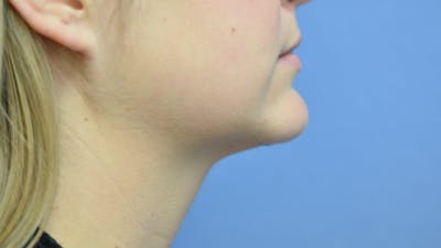 FaceTite Before and After Before & After Gallery - Patient 421934 - Image 2