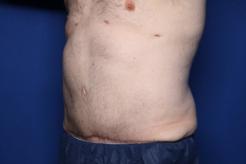 Tummy Tuck Before & After Gallery - Patient 519003 - Image 6