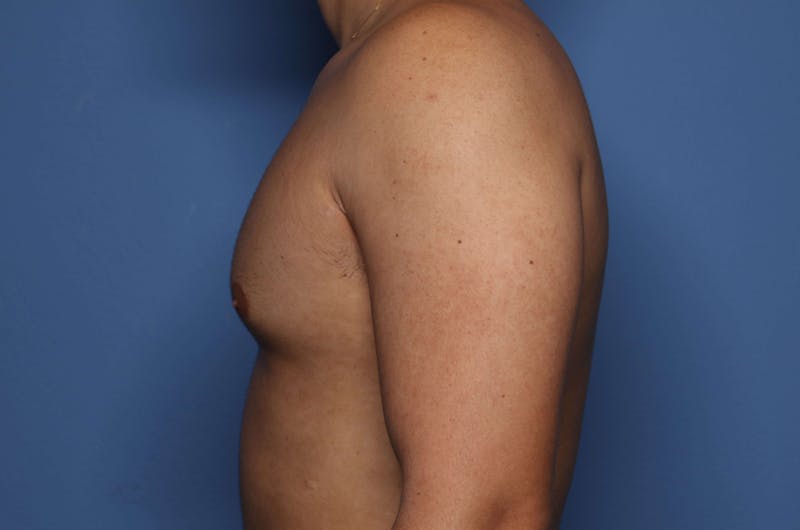 Gynecomastia (Male Breast Reduction) Before & After Gallery - Patient 421321 - Image 3