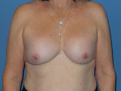 Breast Revision Before & After Gallery - Patient 189978 - Image 1
