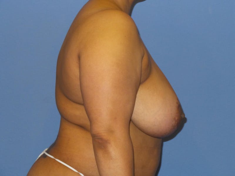 Breast Reduction Before & After Gallery - Patient 259513 - Image 3