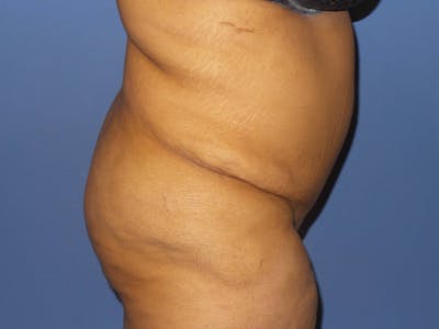 BodyTite™ Before and After Before & After Gallery - Patient 484684 - Image 1