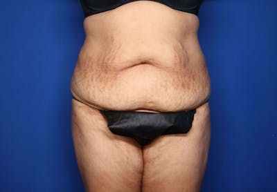 Tummy Tuck Before & After Gallery - Patient 344935 - Image 1