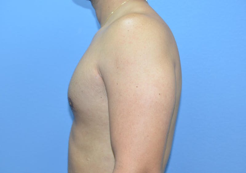 Gynecomastia (Male Breast Reduction) Before & After Gallery - Patient 421321 - Image 4