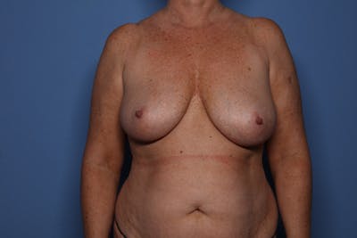 Breast Augmentation + Lift Before & After Gallery - Patient 359745 - Image 1