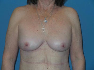 Breast Revision Before & After Gallery - Patient 189978 - Image 2