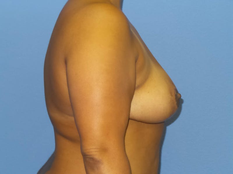 Breast Reduction Before & After Gallery - Patient 259513 - Image 4