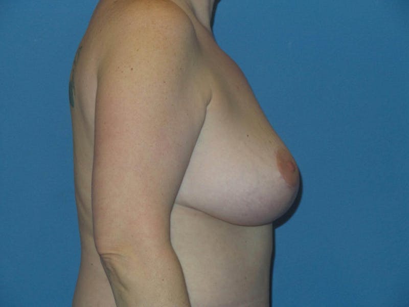 Mommy Makeover Before & After Gallery - Patient 139398 - Image 10