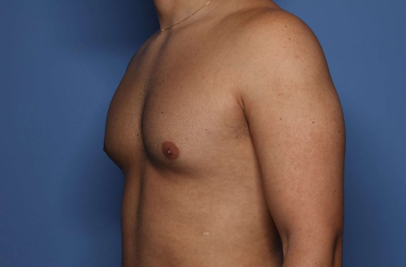 Gynecomastia (Male Breast Reduction) Before & After Gallery - Patient 421321 - Image 5