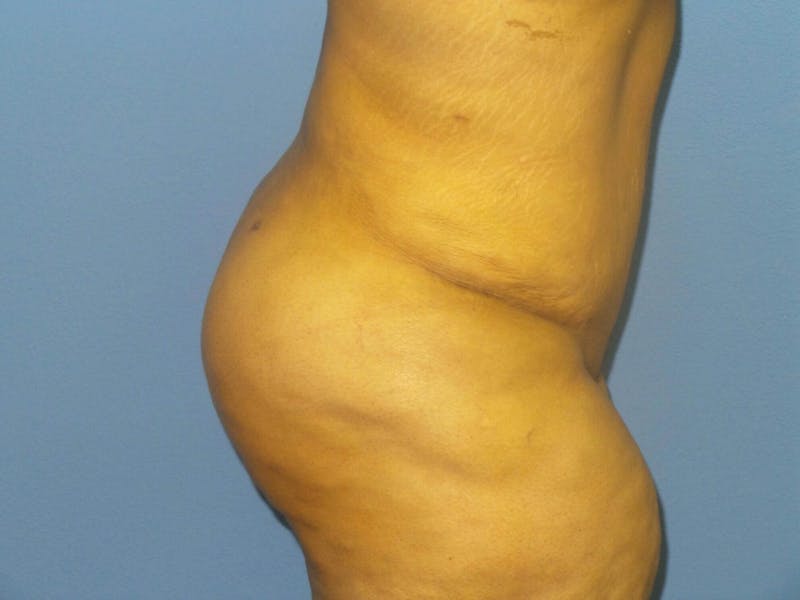 BodyTite™ Before and After Before & After Gallery - Patient 484684 - Image 2