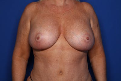 Breast Augmentation + Lift Before & After Gallery - Patient 359745 - Image 2