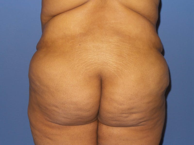 BodyTite™ Before and After Before & After Gallery - Patient 484684 - Image 3