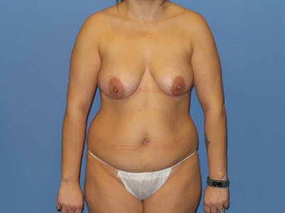 Mommy Makeover Before & After Gallery - Patient 331171 - Image 1