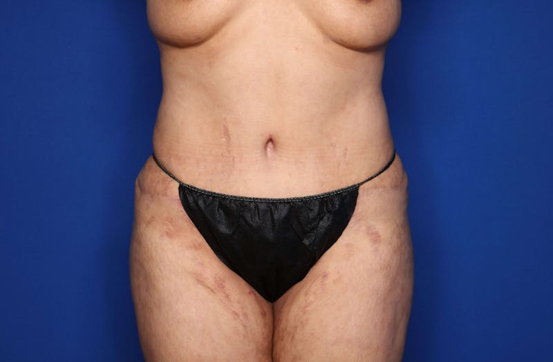 Tummy Tuck Before & After Gallery - Patient 344935 - Image 2