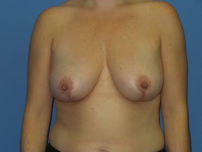 Breast Reduction Before & After Gallery - Patient 108782 - Image 2