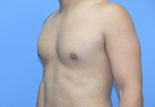 Gynecomastia (Male Breast Reduction) Before & After Gallery - Patient 421321 - Image 6