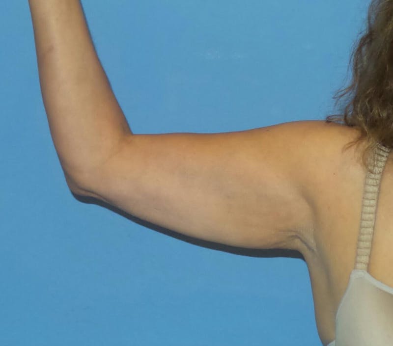 BodyTite™ Before and After Before & After Gallery - Patient 258931 - Image 1
