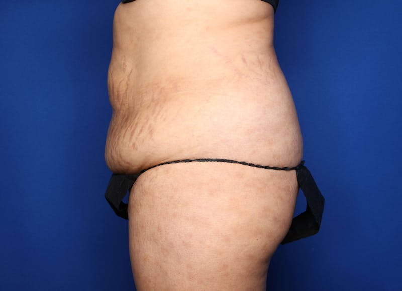 Tummy Tuck Before & After Gallery - Patient 344935 - Image 3