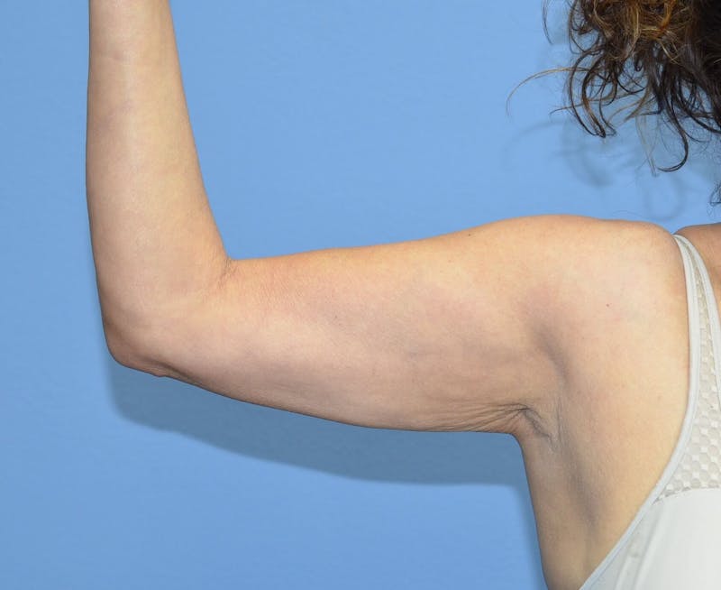 BodyTite™ Before and After Before & After Gallery - Patient 258931 - Image 2