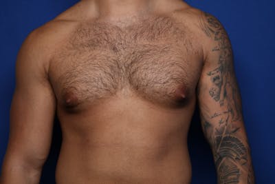 Gynecomastia (Male Breast Reduction) Before & After Gallery - Patient 378481 - Image 1