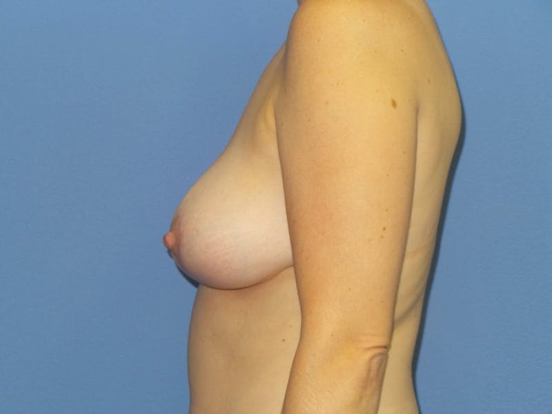 Breast Reduction Before & After Gallery - Patient 108782 - Image 4