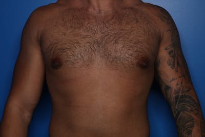 Gynecomastia (Male Breast Reduction) Before & After Gallery - Patient 378481 - Image 2