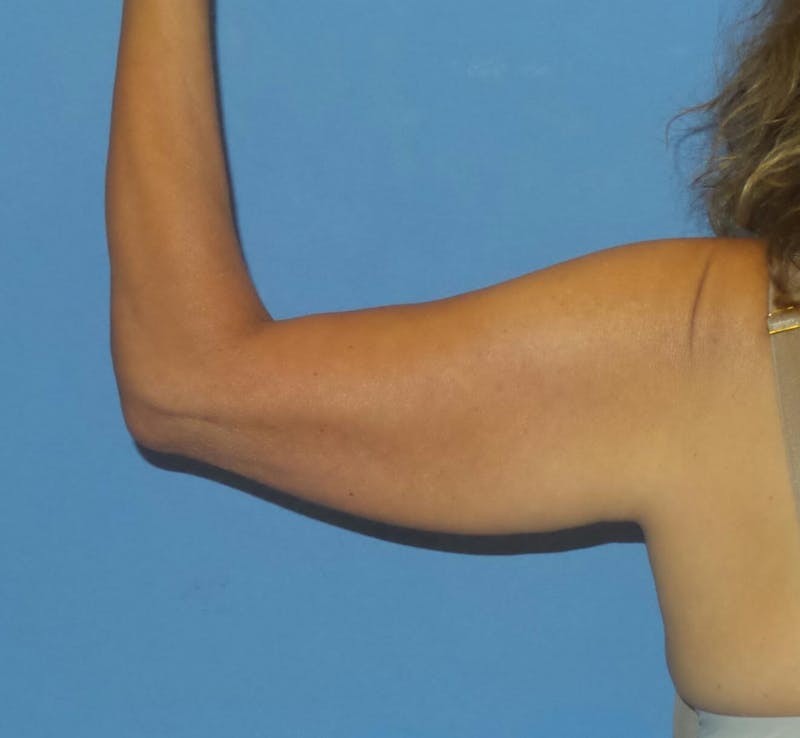 BodyTite™ Before and After Before & After Gallery - Patient 258931 - Image 3