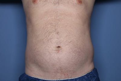 Liposuction Before & After Gallery - Patient 363436 - Image 1