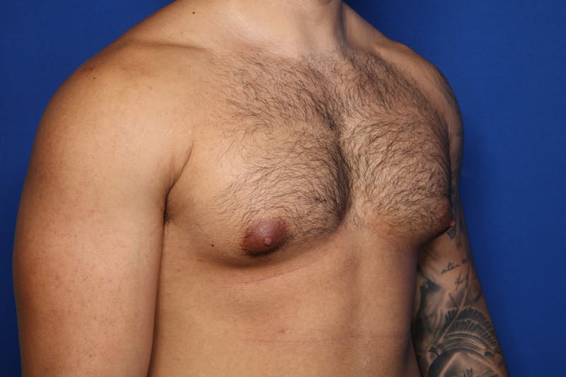 Gynecomastia (Male Breast Reduction) Before & After Gallery - Patient 378481 - Image 3