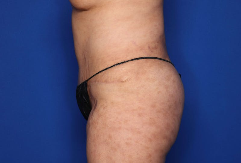 Tummy Tuck Before & After Gallery - Patient 344935 - Image 4