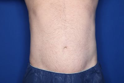 Liposuction Before & After Gallery - Patient 363436 - Image 2
