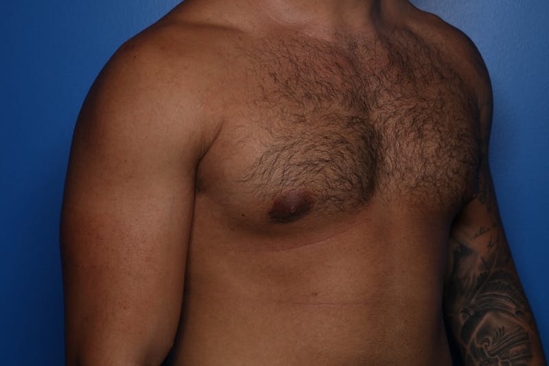 Gynecomastia (Male Breast Reduction) Before & After Gallery - Patient 378481 - Image 4