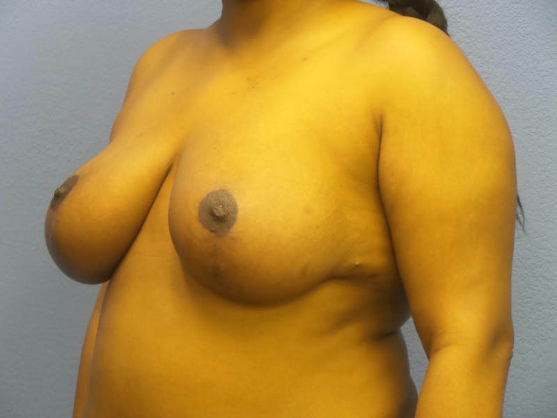 Breast Reduction Before & After Gallery - Patient 162728 - Image 2