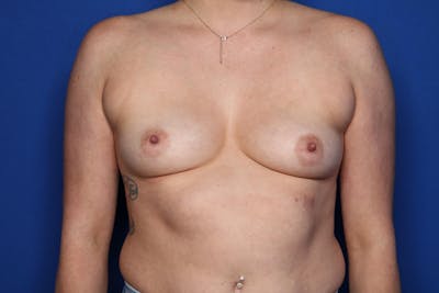 Breast Augmentation Before & After Gallery - Patient 671474 - Image 1